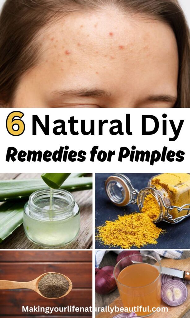 Home remedies for pimples.