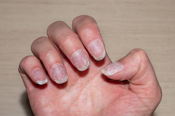 how to fix damaged nails after fake nails