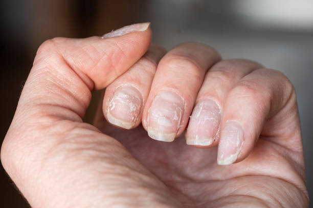 treating damaged nail bed