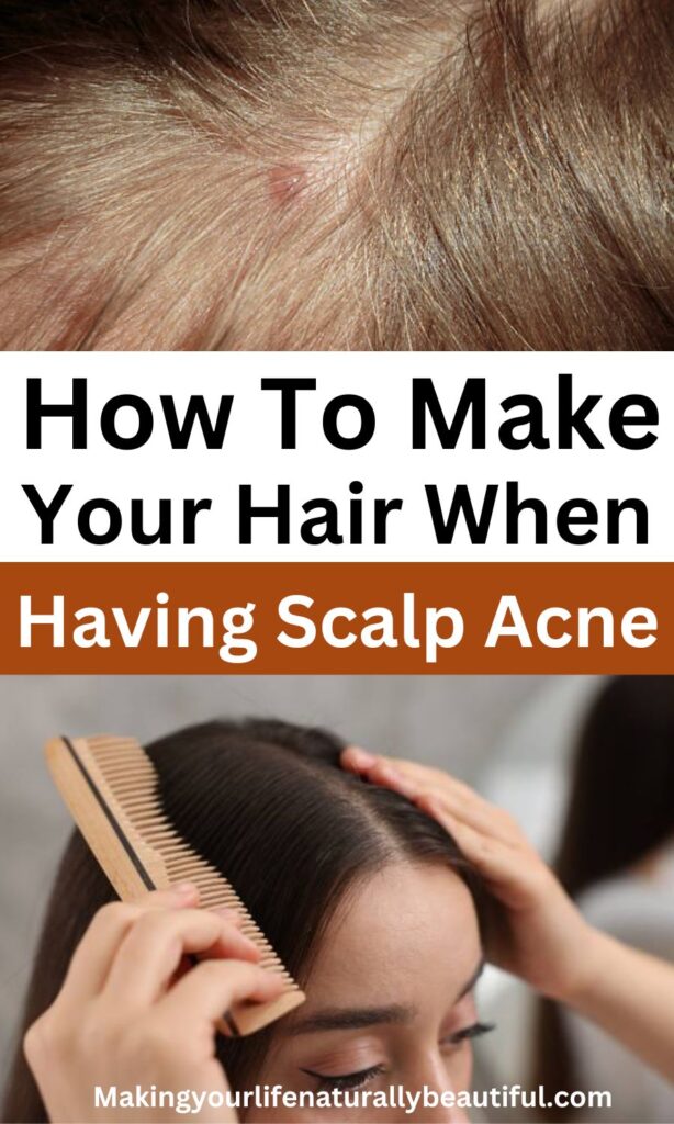 How to manage hair with scalp acne.