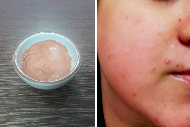 Homemade pink clay mask for oily and acne prone skin